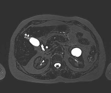 File:Adenomyomatosis of the gallbladder (Radiopaedia 50246-55587 Axial 47).png