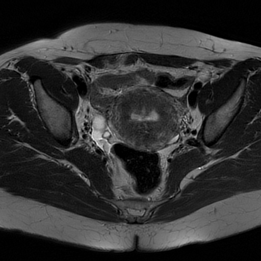 File:Adenomyosis-scar endometriosis (Radiopaedia 65863-75022 Axial T2 14).jpg