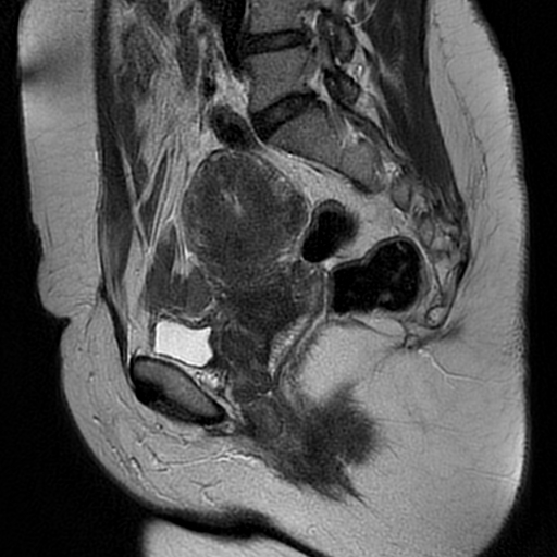 File:Adenomyosis-scar endometriosis (Radiopaedia 65863-75022 Sagittal T2 11).jpg