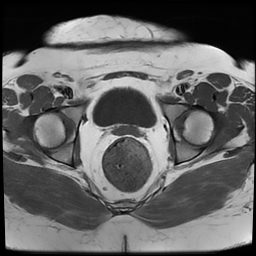 File:Adenomyosis within a didelphys uterus (Radiopaedia 70175-80215 Axial T1 32).jpg