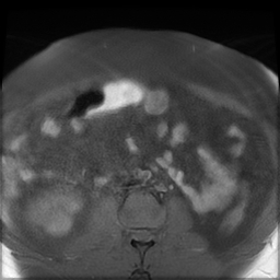 File:Adenomyosis within a didelphys uterus (Radiopaedia 70175-80215 Axial T1 fat sat 2).jpg