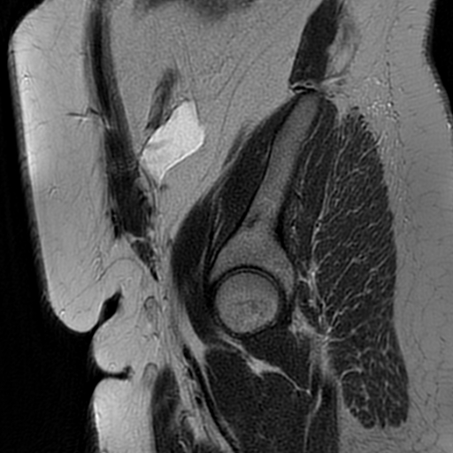 File:Adenomyosis within a didelphys uterus (Radiopaedia 70175-80215 Sagittal T2 37).jpg