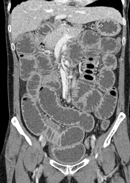 File:Adhesional small bowel obstruction (Radiopaedia 48397-53305 Coronal C+ portal venous phase 143).jpg