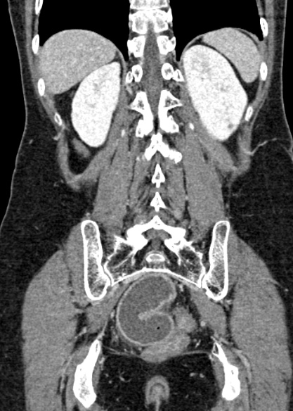 Adhesional small bowel obstruction (Radiopaedia 48397-53305 Coronal C+ portal venous phase 271).jpg
