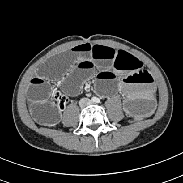 File:Adhesional small bowel obstruction (Radiopaedia 52107-57980 Axial C+ portal venous phase 73).jpg