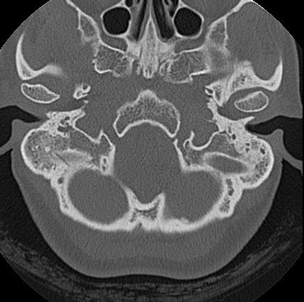 File:Adhesive chronic otitis media (Radiopaedia 14270-14148 Axial bone window 19).jpg