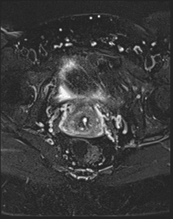 File:Adnexal multilocular cyst (O-RADS US 3- O-RADS MRI 3) (Radiopaedia 87426-103754 Axial T2 fat sat 18).jpg
