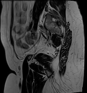 File:Adnexal multilocular cyst (O-RADS US 3- O-RADS MRI 3) (Radiopaedia 87426-103754 Sagittal T2 3).jpg