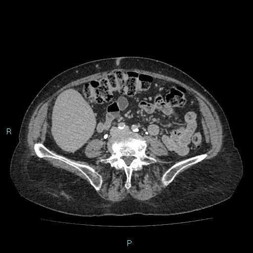 File:Adrenal collision tumor (ACT) (Radiopaedia 48462-53379 Axial C+ delayed 40).jpg
