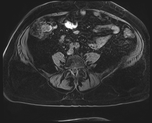 Adrenal cortical carcinoma (Radiopaedia 64017-72770 Axial T1 C+ fat sat 55).jpg