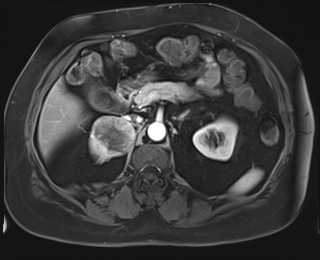 Adrenal cortical carcinoma (Radiopaedia 64017-72770 I 36).jpg