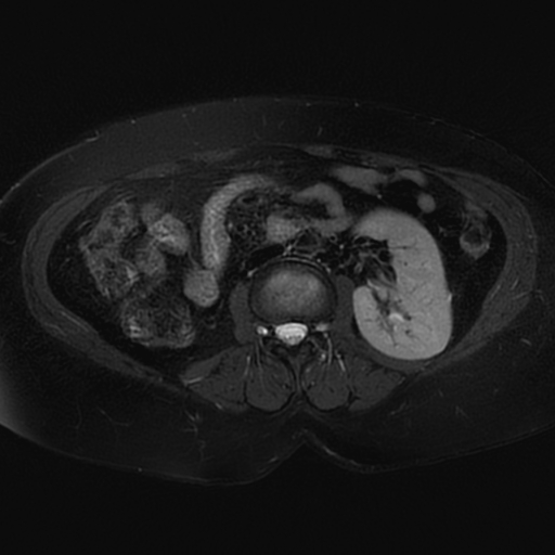 File:Adrenal cortical carcinoma (Radiopaedia 70906-81116 Axial T2 fat sat 33).jpg