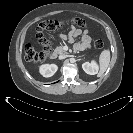 File:Adrenal cyst (Radiopaedia 45625-49778 AXIAL THICK 60 sec 29).png