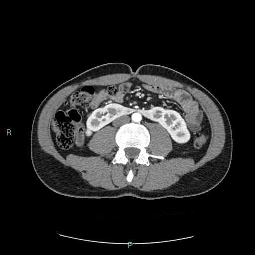 Adrenal cystic lymphangioma (Radiopaedia 83161-97534 Axial C+ arterial phase 53).jpg