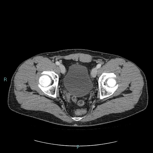 Adrenal cystic lymphangioma (Radiopaedia 83161-97534 Axial C+ portal venous phase 90).jpg