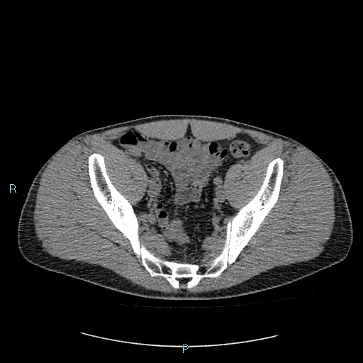 Adrenal cystic lymphangioma (Radiopaedia 83161-97534 Axial non-contrast 81).jpg