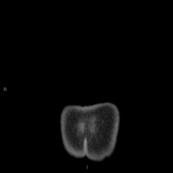 Adrenal cystic lymphangioma (Radiopaedia 83161-97534 Coronal C+ portal venous phase 81).jpg
