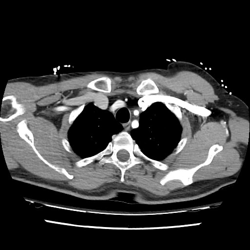 Adrenal gland trauma (Radiopaedia 81351-95078 Axial Dual bolus trauma C+ 17).jpg