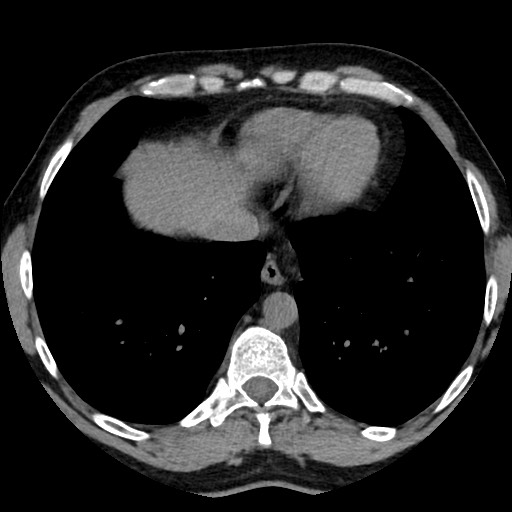 File:Adrenal gland trauma (Radiopaedia 81351-95079 Axial non-contrast 7).jpg