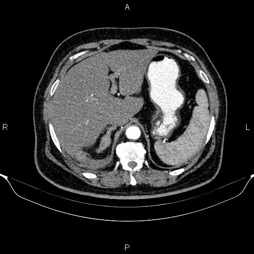 Adrenal hemorrhage (Radiopaedia 62622-70916 Axial C+ arterial phase 74).jpg