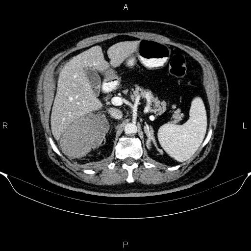 Adrenal hemorrhage (Radiopaedia 62622-70916 Axial C+ portal venous phase 56).jpg
