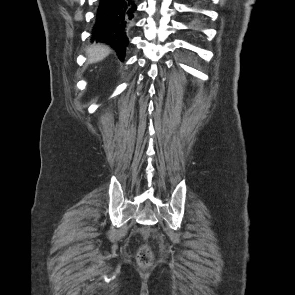 Adrenal lymphoma (Radiopaedia 84145-99415 Coronal C+ portal venous phase 77).jpg