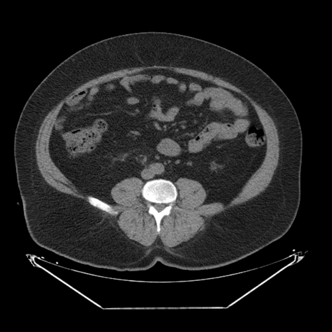 Adrenal myelolipoma (Radiopaedia 26278-26407 Axial non-contrast 42).jpg