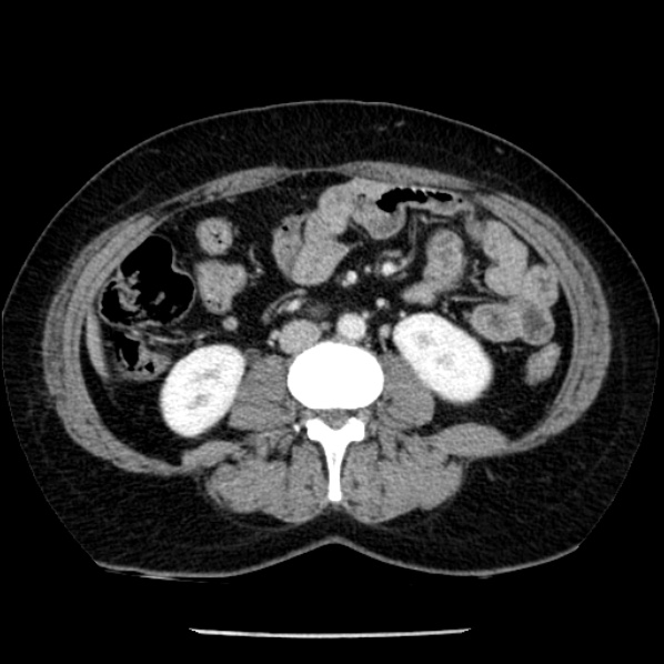 File:Adrenal myelolipoma (Radiopaedia 43401-46759 Axial C+ portal venous phase 46).jpg