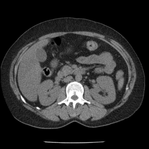 Adrenal myelolipoma (Radiopaedia 43401-46759 Axial non-contrast 36).jpg