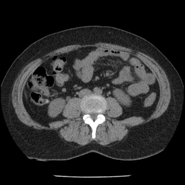 Adrenal myelolipoma (Radiopaedia 43401-46759 Axial non-contrast 48).jpg