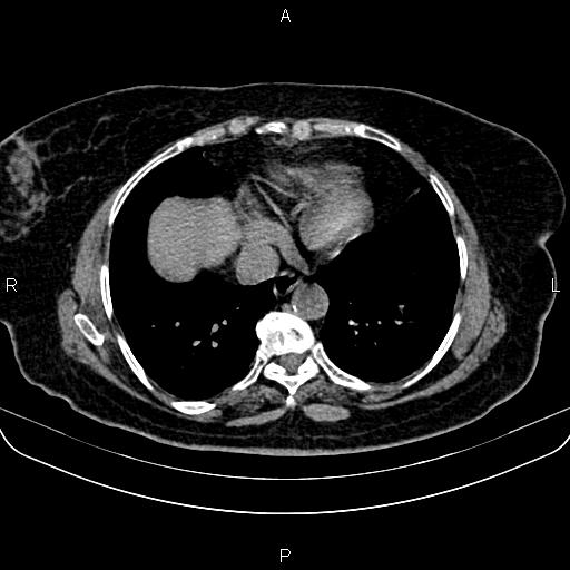 Adrenal myelolipoma (Radiopaedia 82742-96986 Axial non-contrast 2).jpg