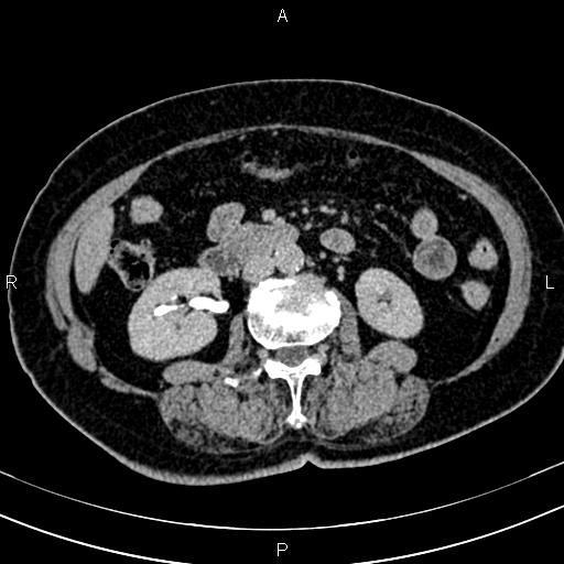 Adrenal myelolipoma (Radiopaedia 82742-96986 Axial renal excretory phase 73).jpg
