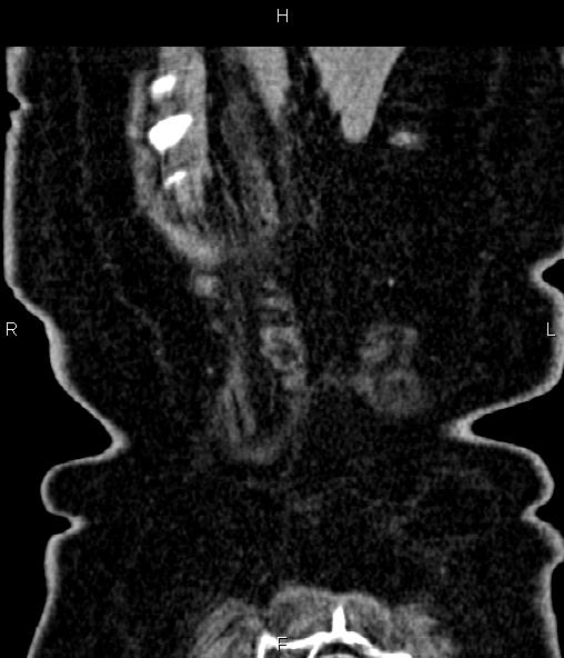 File:Adrenal myelolipoma (Radiopaedia 82742-96986 Coronal renal cortical phase 73).jpg