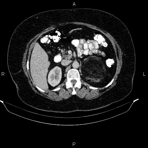 File:Adrenal myelolipoma (Radiopaedia 84319-99617 Axial renal cortical phase 44).jpg