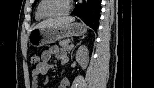 Adrenal myelolipoma (Radiopaedia 84321-99619 Sagittal non-contrast 71).jpg