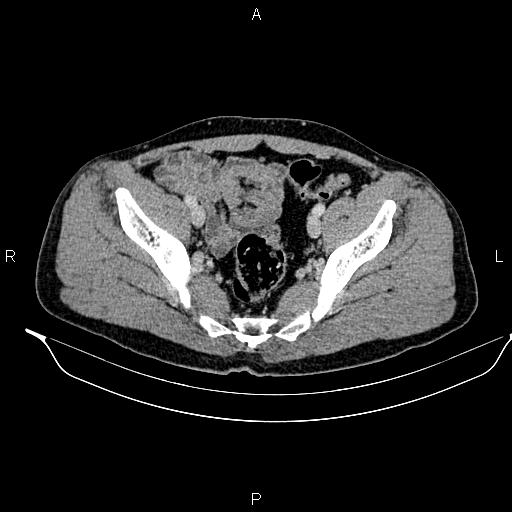 Adrenal myelolipoma (Radiopaedia 87794-104246 Axial renal cortical phase 90).jpg