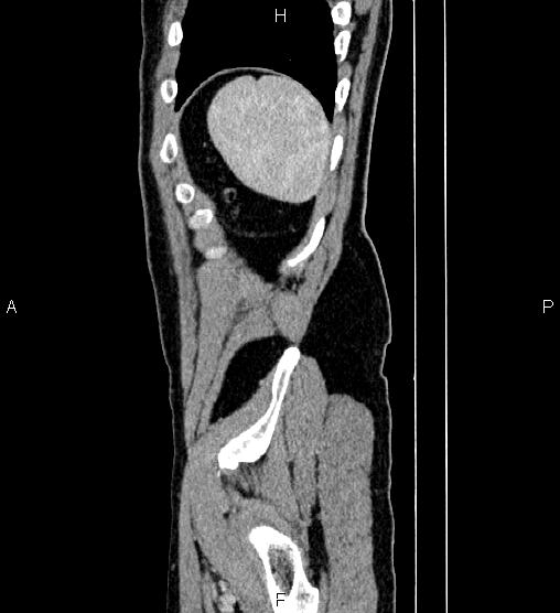 Adrenal myelolipoma (Radiopaedia 87794-104246 Sagittal renal cortical phase 86).jpg