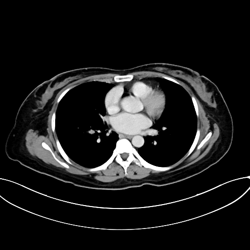 Adrenocortical carcinoma (Radiopaedia 87281-103569 Axial C+ portal venous phase 3).jpg