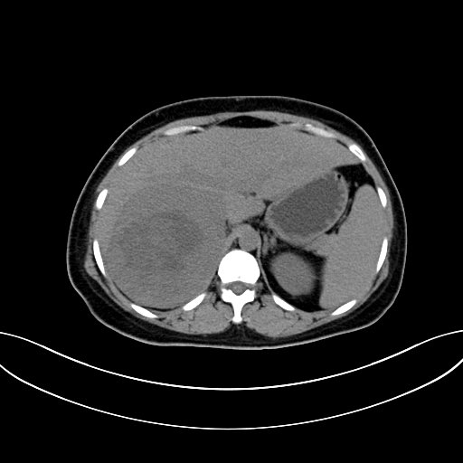Adrenocortical carcinoma (Radiopaedia 87281-103569 Axial non-contrast 25).jpg
