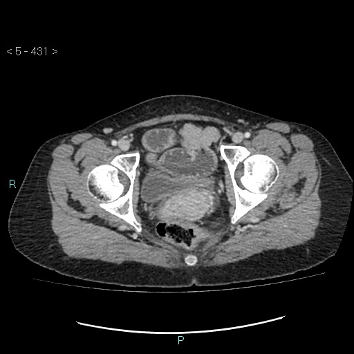 Adult transient intestinal intussusception (Radiopaedia 34853-36310 Axial C+ portal venous phase 114).jpg
