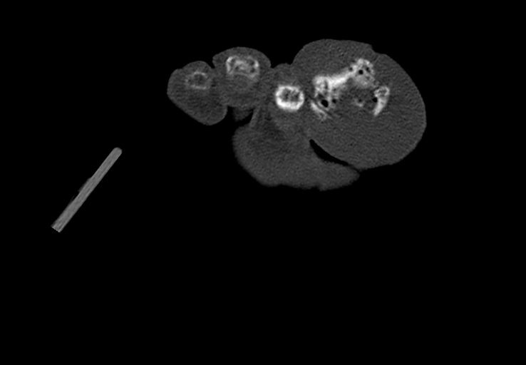 Advanced osteomyelitis due to open metatarsal fracture (Radiopaedia 83891-99095 Axial bone window 51).jpg