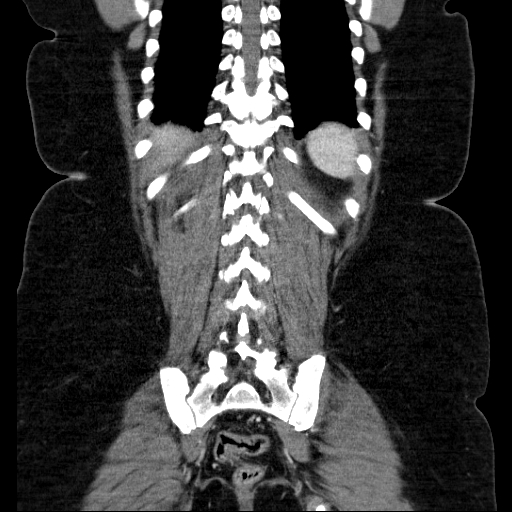 File:Afferent loop syndrome - secondary to incarcerated trocar site hernia (Radiopaedia 82959-97305 Coronal C+ portal venous phase 117).jpg