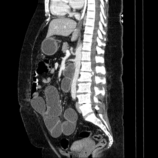 Afferent loop syndrome - secondary to incarcerated trocar site hernia (Radiopaedia 82959-97305 Sagittal C+ portal venous phase 76).jpg