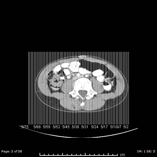 Agenesis of the gallbladder (Radiopaedia 55454-61905 B 3).jpg