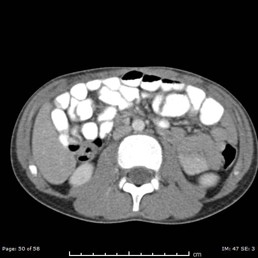 File:Agenesis of the gallbladder (Radiopaedia 55454-61905 B 50).jpg