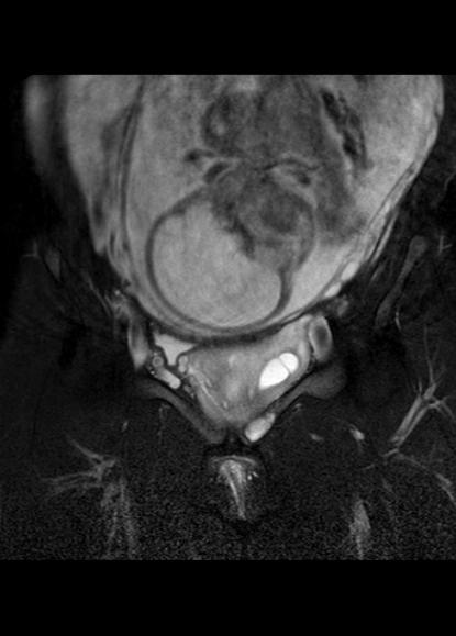 File:Aggressive angiomyxoma of the pelvis and perineum (Radiopaedia 59162-66479 Coronal T2 fat sat 8).jpg