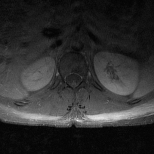 File:Aggressive vertebral hemangioma (Radiopaedia 39937-42404 Axial T1 C+ fat sat 4).png