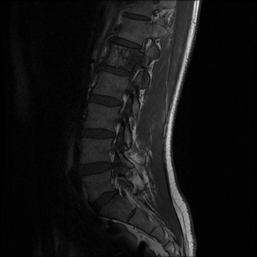 File:Aggressive vertebral hemangioma with pathological fracture (Radiopaedia 69528-79411 Sagittal T1 3).jpg
