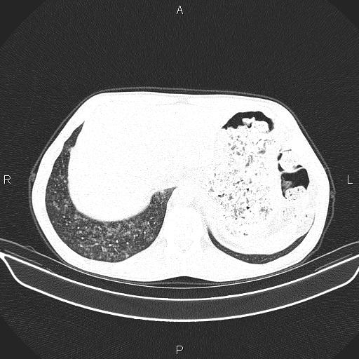 Air bronchogram in pneumonia (Radiopaedia 85719-101512 Axial lung window 62).jpg