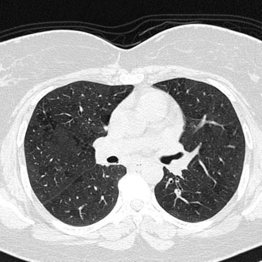 File:Air trapping in small airway disease (Radiopaedia 61685-69694 Axial lung window 79).jpg